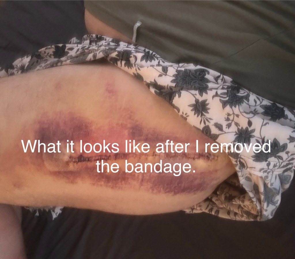 Biomechanical enlightenment and my hip surgery.